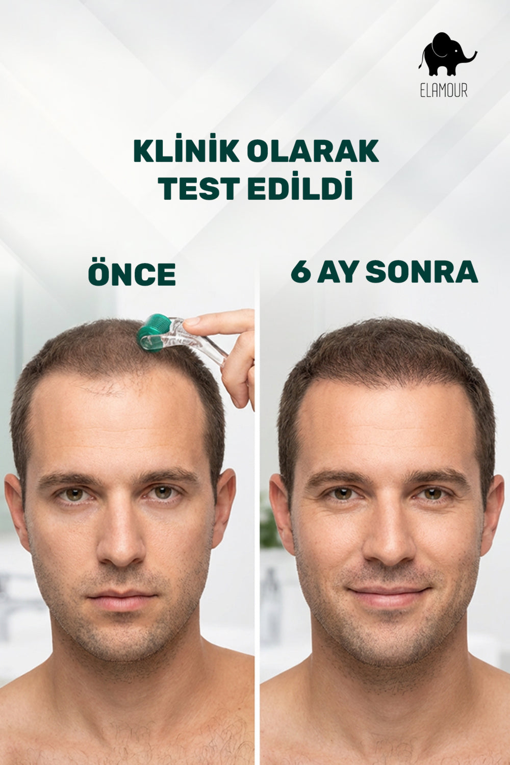 Derma Roller Nedir ve Cilde Ne Yapar? Bilimsel Verilerle Eksiksiz Rehber