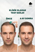 540 Titanyum İğneli Dermaroller - Dezenfektan Hediyeli - 0,50mm İğneli -  Saç Ve Cilt Bakım
